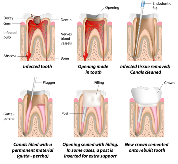 Chart - Root Canal Process